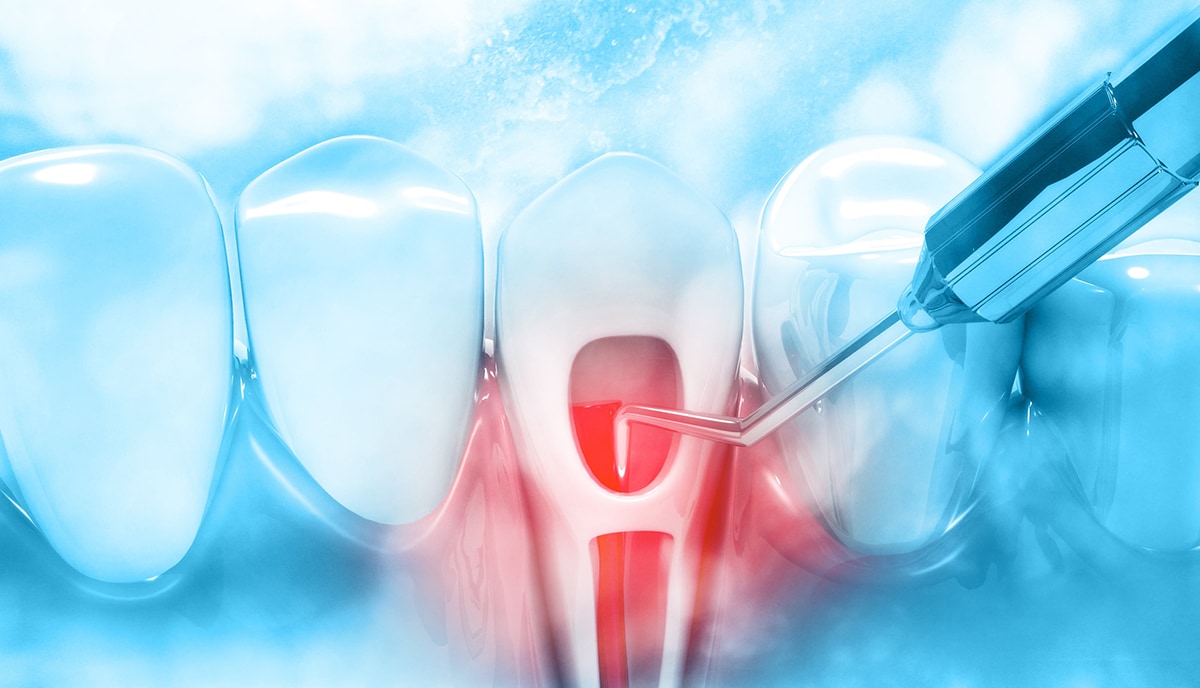 雷射治療-雷射植牙-雷射牙周病-雷射美白-台北牙醫推薦-悅庭牙醫