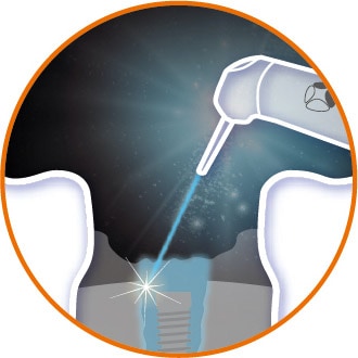 雷射治療應用-植牙-台北牙醫-悅庭牙醫