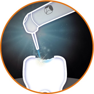 雷射治療應用-牙體修復-台北牙醫-悅庭牙醫
