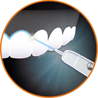 雷射治療應用-美學牙科-台北牙醫-悅庭牙醫