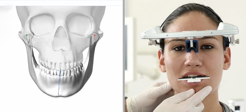顳顎關節障礙治療-SICAT關節與下顎運動功能檢驗儀器-悅庭牙醫-台北