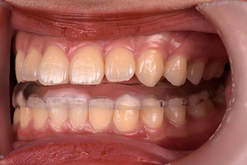 顳顎關節障礙治療-前置型咬合板-悅庭牙醫-台北