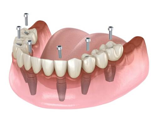 Bio All X 碧歐適植牙式固定全顎牙橋 悅庭牙醫診所 台北牙醫推薦