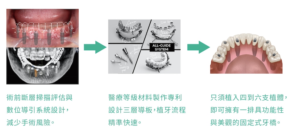 bio-all-x-全口重建-碧歐適植牙-固定全顎牙橋優點-悅庭牙醫-台北