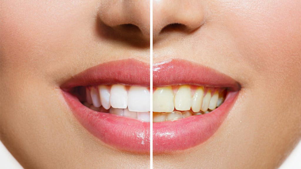 牙齒美白-噴砂美白-雷射美白-齒內美白-居家美白-台北牙醫推薦-悅庭牙醫