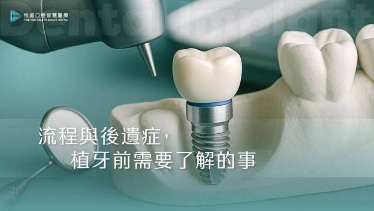 流程與後遺症，植牙前需要了解的事