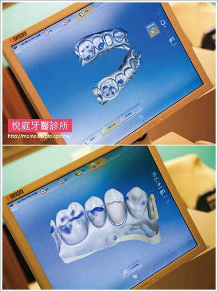TCI舒眠牙醫-導引式植牙-台北-悅庭牙醫-全口攝影口內取像儀-2-momo