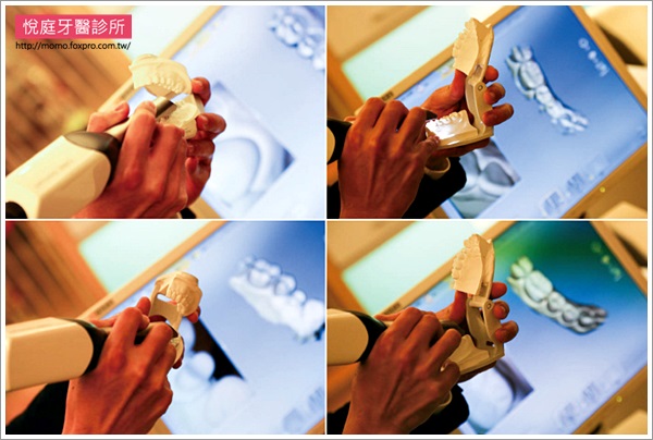TCI舒眠牙醫-導引式植牙-台北-悅庭牙醫-全口攝影口內取像儀-4-momo