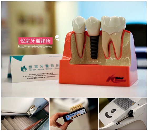 TCI舒眠牙醫-導引式植牙-台北-悅庭牙醫-植牙模型-momo