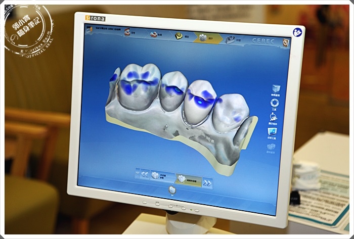 全瓷冠-假牙-牙套-導引式植牙-悅庭牙醫-全彩攝影口內取像儀-3-郭小寶