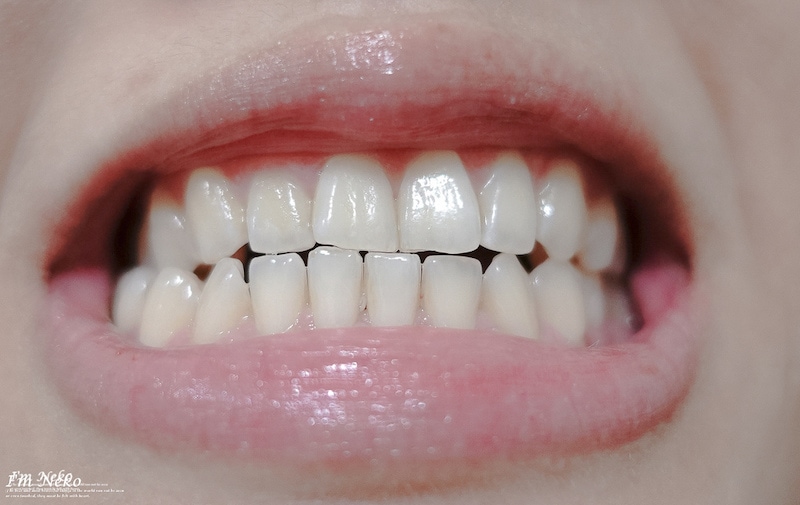 牙齒美白-台北-居家美白-推薦-悅庭牙醫-居家美白療程前-牙齒顏色-Neko