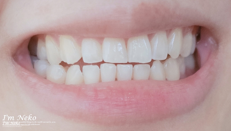 牙齒美白-台北-居家美白-推薦-悅庭牙醫-居家美白療程半月後-牙齒顏色-Neko