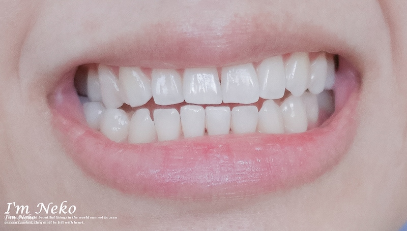 牙齒美白-台北-居家美白-推薦-悅庭牙醫-居家美白療程後-牙齒顏色-Neko