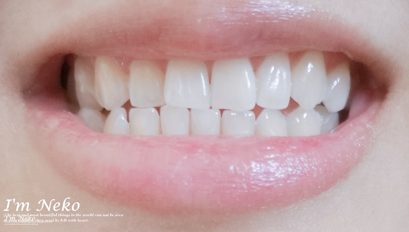 牙齒美白-台北-居家美白-推薦-悅庭牙醫-居家美白療程後半個月-牙齒顏色-Neko