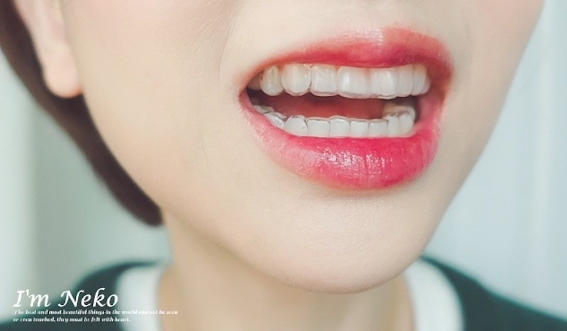 牙齒美白-台北-居家美白-推薦-悅庭牙醫-居家美白過程-配戴注入美白藥劑的牙托-1-Neko