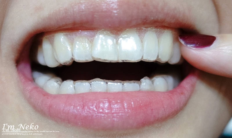 牙齒美白-台北-居家美白-推薦-悅庭牙醫-居家美白過程-配戴注入美白藥劑的牙托-2-Neko