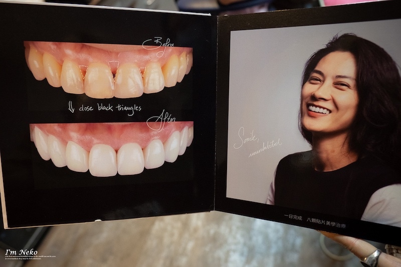 牙齒美白-台北-居家美白-推薦-悅庭牙醫-瓷牙貼片案例-1-Neko