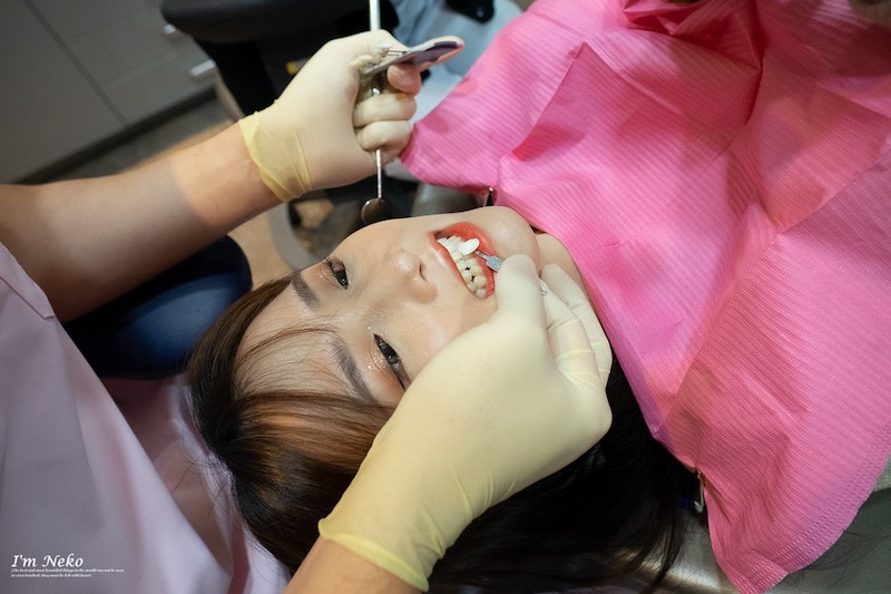牙齒美白-台北-居家美白-推薦-悅庭牙醫-療程前牙齒比色-Neko