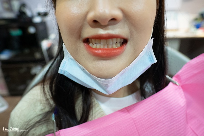 牙齒美白-台北-居家美白-推薦-悅庭牙醫-療程前牙齒顏色-Neko