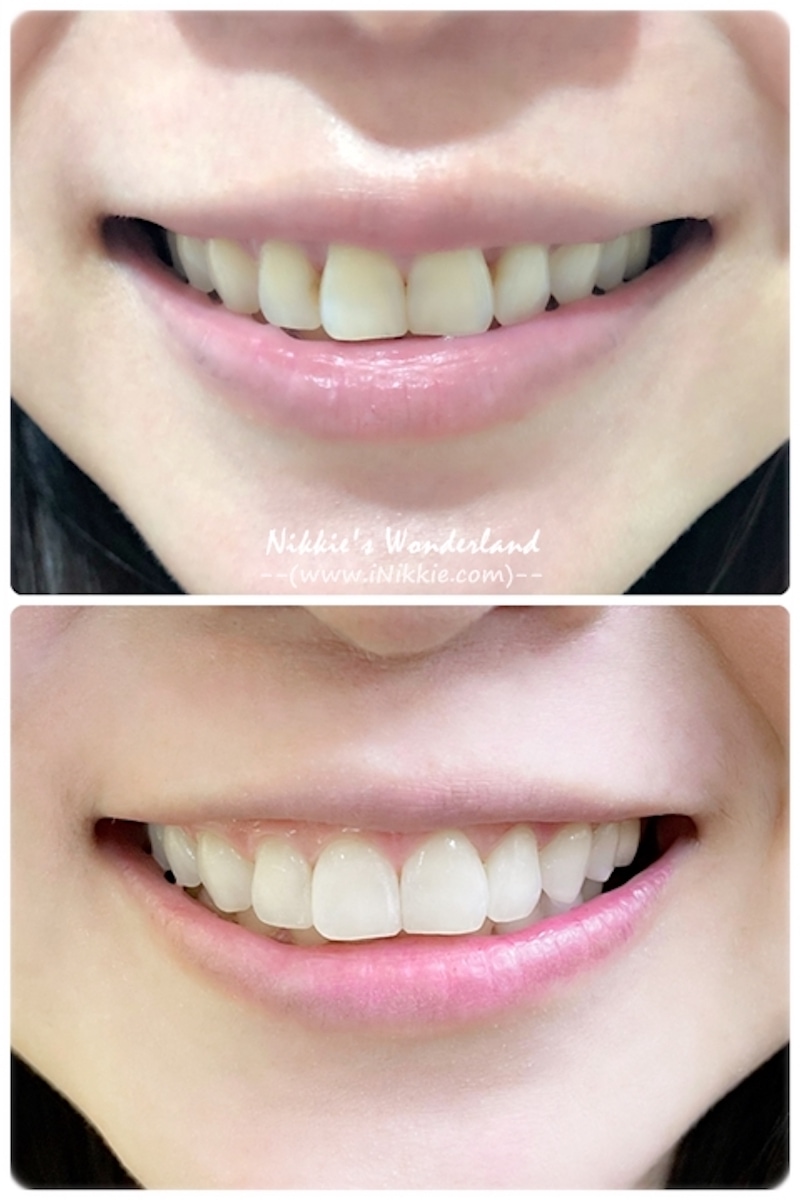 牙齒美白-居家美白-台北-悅庭牙醫-居家美白療程前後對比-Nikkie