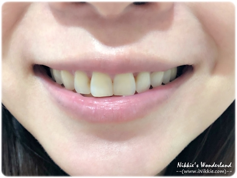 牙齒美白-居家美白-台北-悅庭牙醫-療程前-牙齒黃-Nikkie