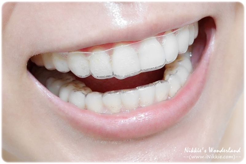 牙齒美白-居家美白-台北-悅庭牙醫-配戴裝有漂白藥劑的牙托-前牙近照-Nikkie