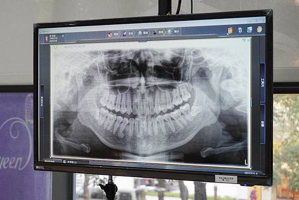 瓷牙貼片-全瓷冠-台北牙醫-推薦-悅庭牙醫-全口X光片-Kelly