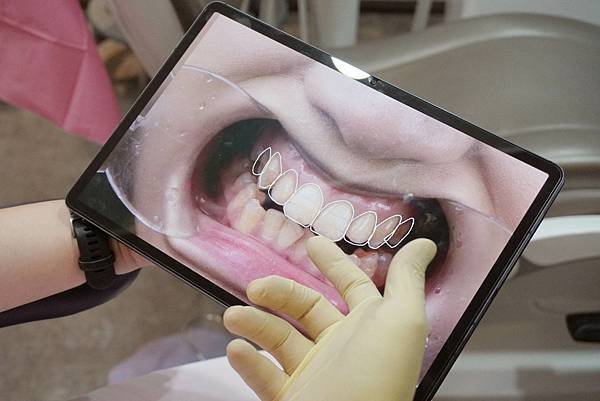 瓷牙貼片-全瓷冠-台北牙醫-推薦-悅庭牙醫-微笑曲線牙齒設計-Kelly
