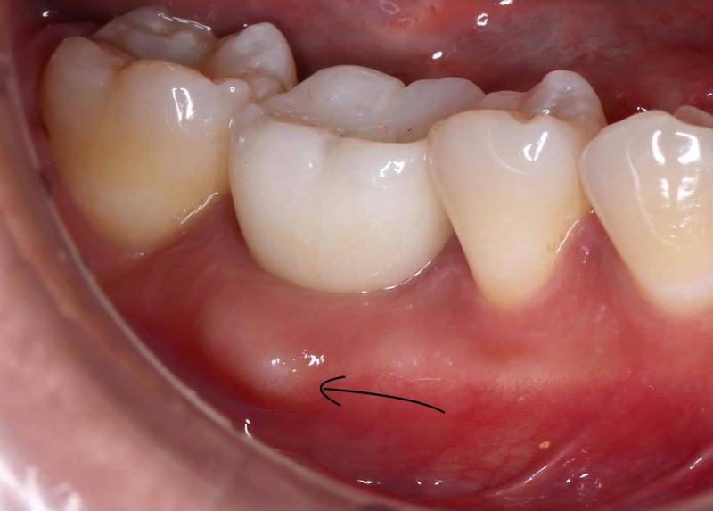圖／骨疣是由口腔顎骨的皮質骨增生產生的