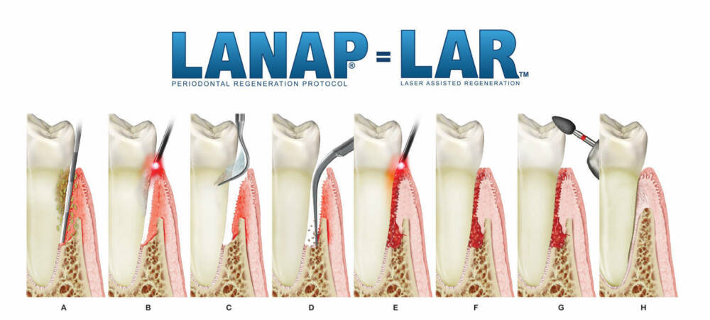 LANAP(Laser-assisted new attachment procedure)，是一種用雷射輔助的牙周病治療方法。