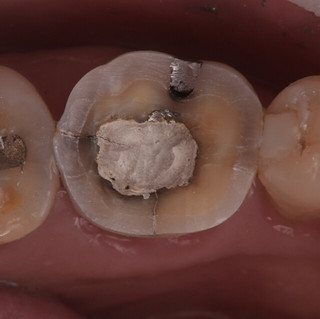 圖／因大範圍銀汞合金填補造成的牙齒的小裂紋
