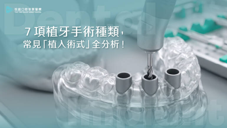 ７項植牙手術種類，常見「植入術式」全分析！