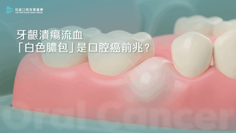 牙齦潰瘍流血「白色膿包」是口腔癌前兆？