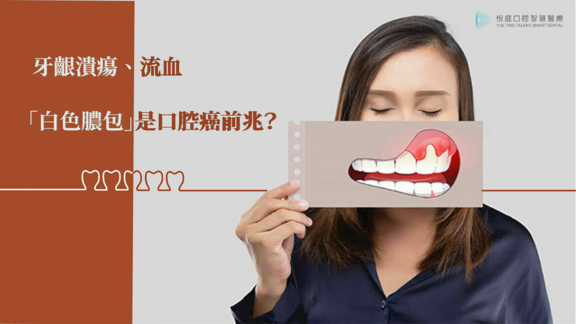 牙齦潰瘍流血「白色膿包」是口腔癌前兆？