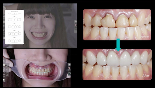 圖／DSD數位微笑設計模擬牙齒規劃前與規劃後樣貌