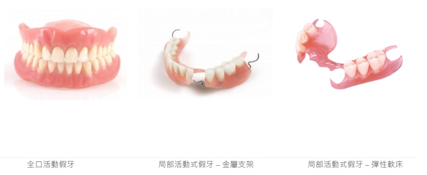 圖/全口或局部活動式假牙