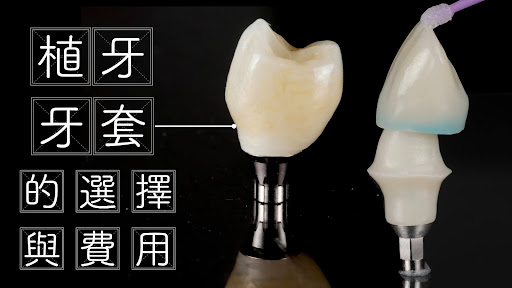 【全瓷冠植牙】不只牙套材質與價格，「牙體技術師」更是關鍵