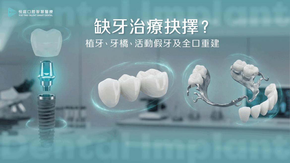缺牙治療抉擇？植牙、牙橋、活動假牙及全口重建
