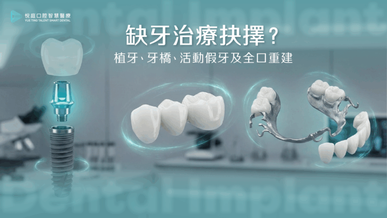 缺牙治療抉擇？植牙、牙橋、活動假牙及全口重建
