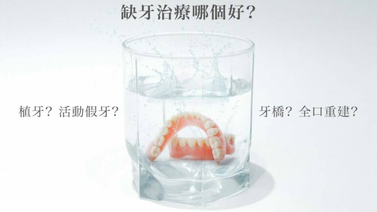 缺牙治療抉擇？植牙、牙橋、活動假牙及全口重建