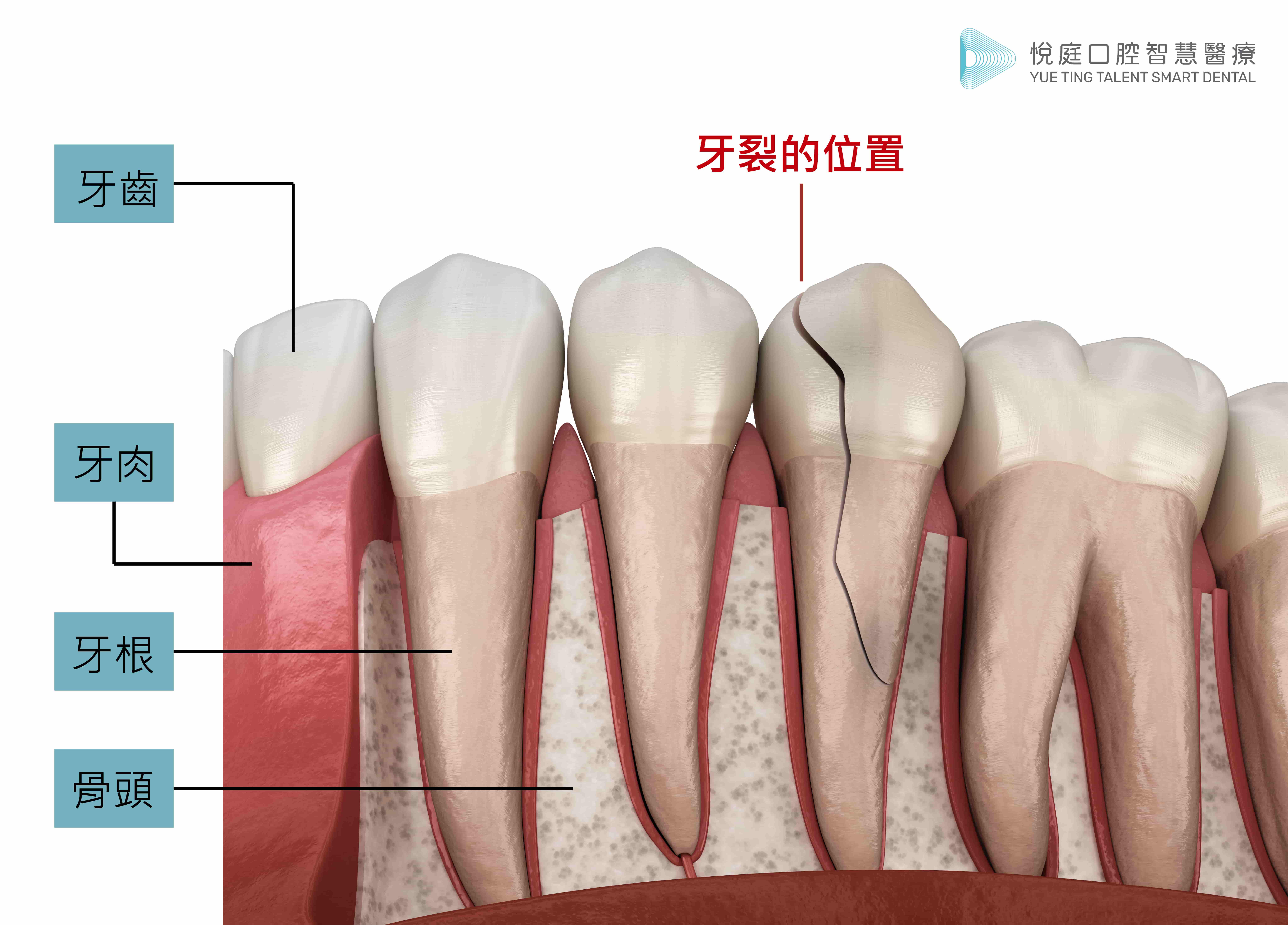 圖例/因無法看到骨頭內牙根的情況，因此有可能裂痕深至牙根