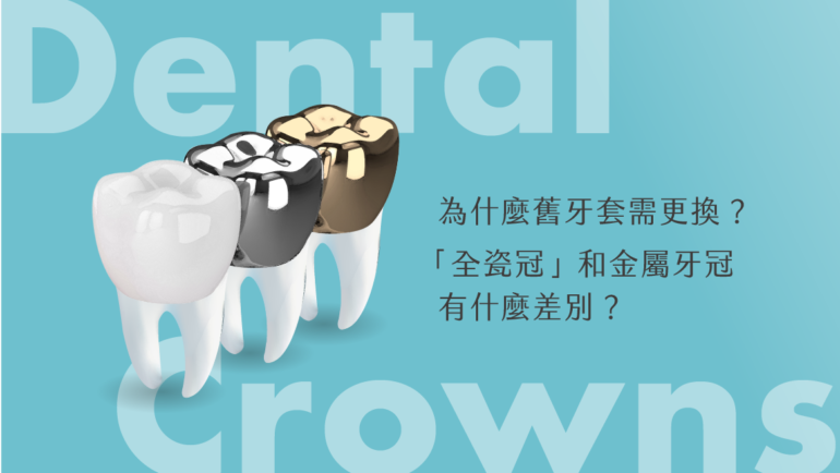 為什麼舊牙套需更換？「全瓷冠」和金屬牙冠有什麼差別？