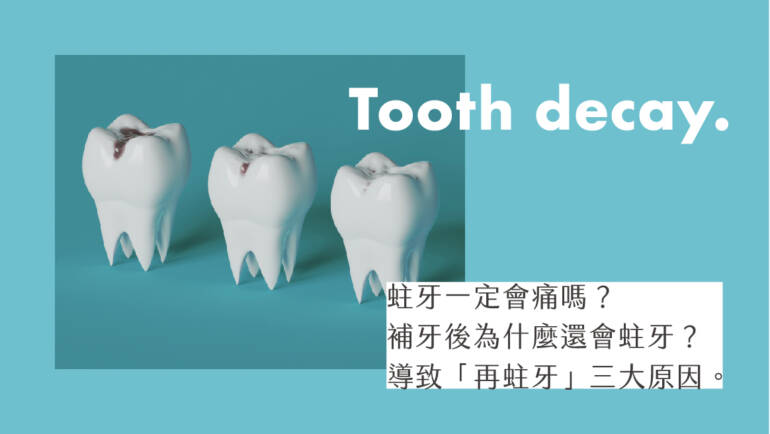 蛀牙一定會痛嗎？補牙後導致「再蛀牙」的3大原因