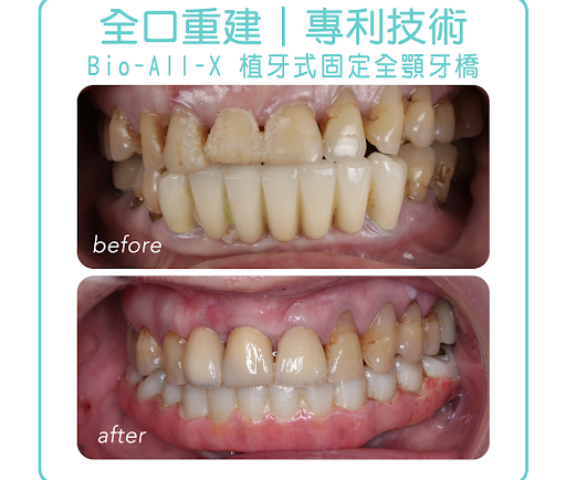 大範圍缺牙治療，舊牙橋換「BIO-ALL-X 碧歐適植牙式固定全顎牙橋」劉女士案例