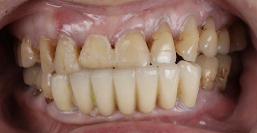 治療前：下排牙齒有7顆是牙橋，長度、顏色皆顯得不自然。有牙齦萎縮、牙周病問題
