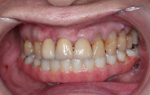 治療後：下排牙齒為「碧歐適植牙式固定全顎牙橋」，上排以植牙、貼片完成治療。牙周病已緩解，僅有部分因年邁自然的牙齦萎縮