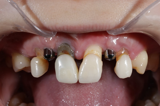 圖/利用矯正調整患者牙齒位置，缺牙區以最小限度放入植體；雷射治療刺激牙周組織再生，加速恢復。