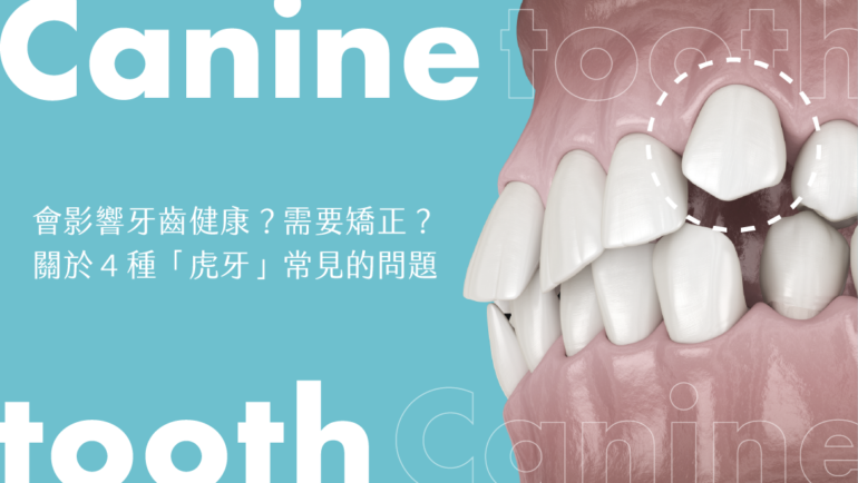 會影響牙齒健康？需要矯正？關於４種「虎牙」常見的問題