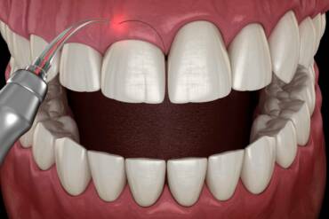 牙齦整形手術