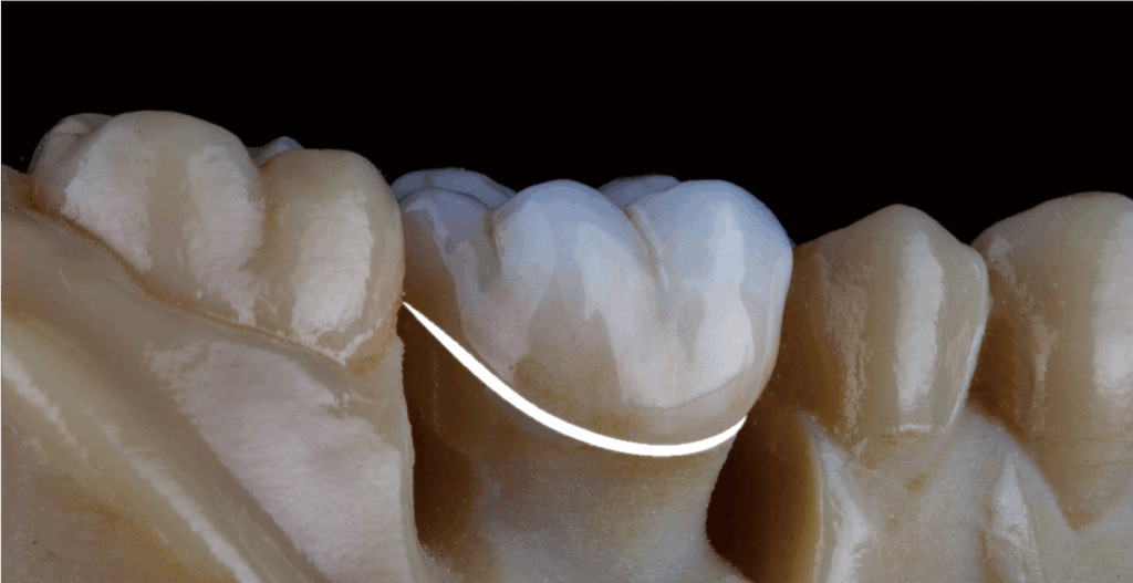 雪曜瓷Pro-氟離子釋放-預防全瓷冠內蛀牙-全瓷冠-悅庭牙醫診所-台北